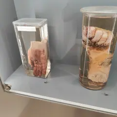 Narrenturm - Pathologisch-anatomische Sammlung